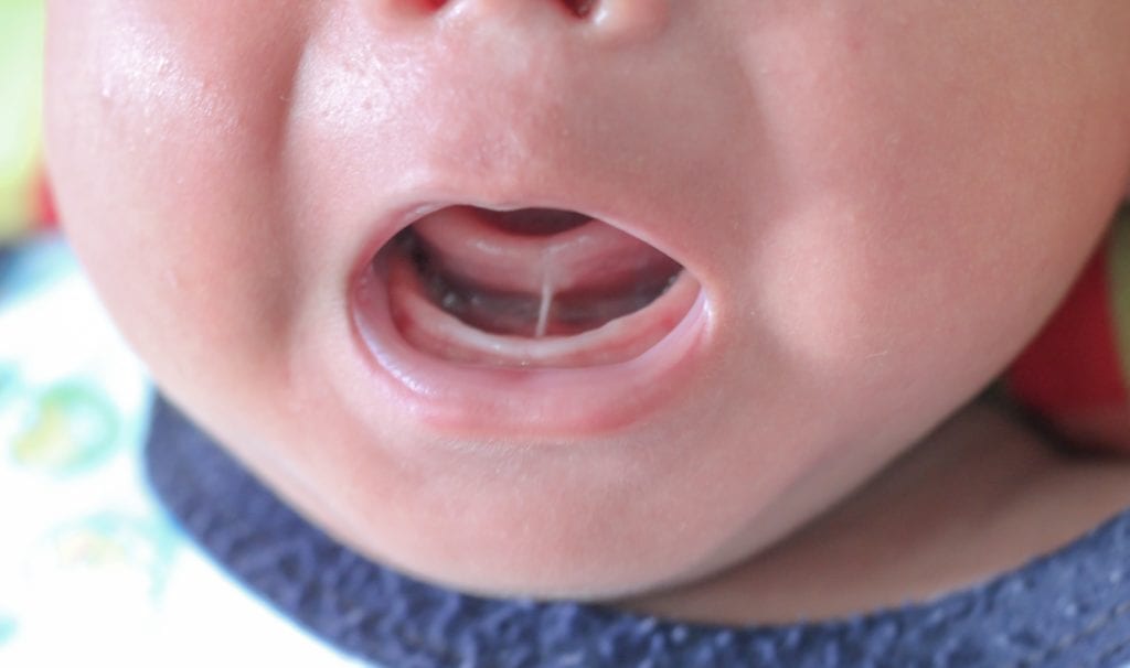 infant with tongue tie