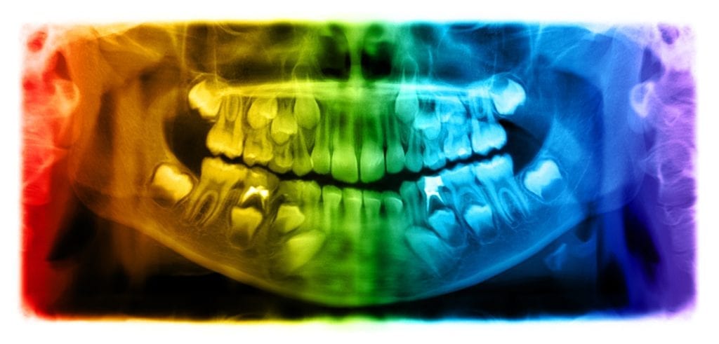 dental x-ray of impacted teeth