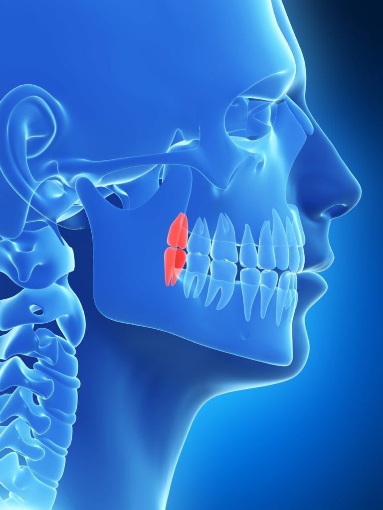 wisdom teeth shown in skull