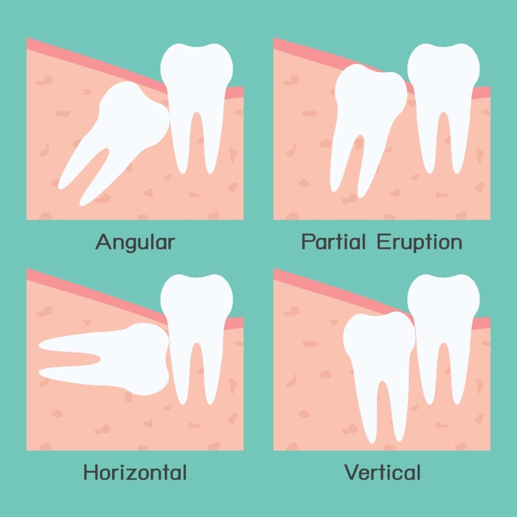 types of wisdom teeth impactions