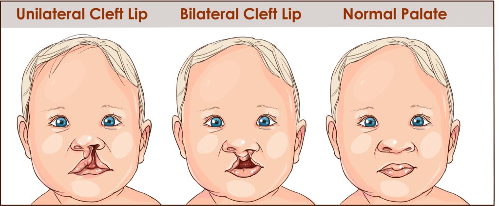 cleft lip and palate