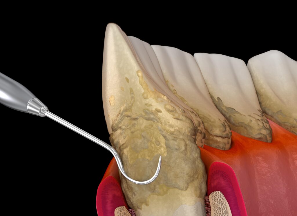 deep cleaning for periodontal disease