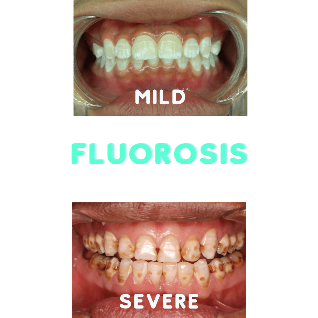 mild and severe cases of fluorosis 