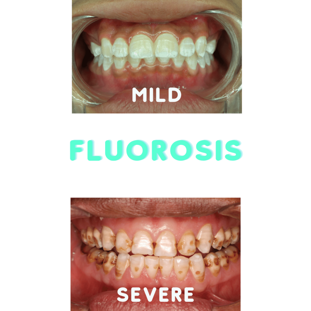 mild and severe cases of fluorosis 