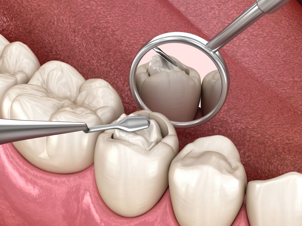 dental composite being placed in a cavity
