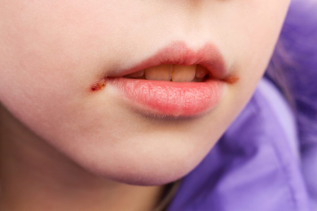 child with a cold sore on lips