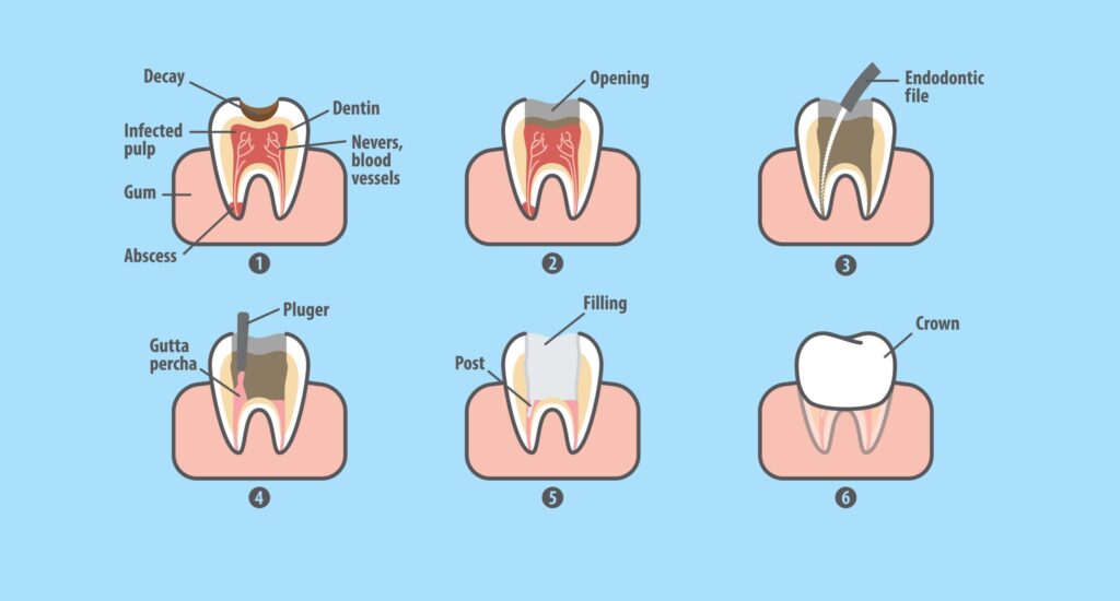 steps of a root canal