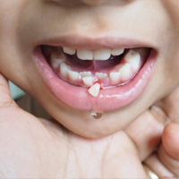 img-Knocked-Out Tooth