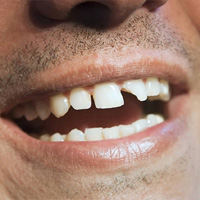 img-Chipped or Broken Tooth