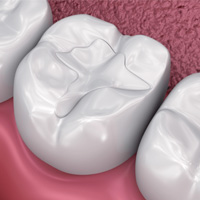 img-Tooth-Colored Fillings